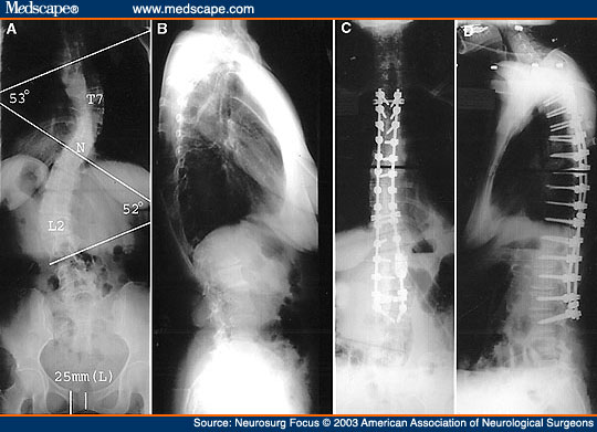 Back Surgery To Correct Scoliosis In Adults