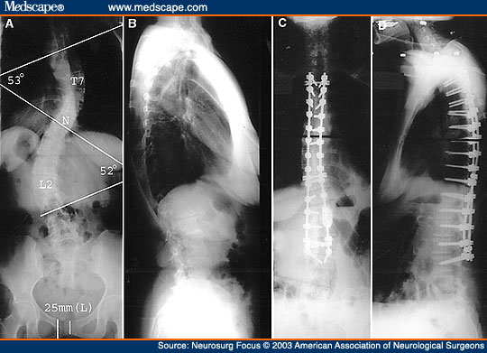 Men With Scoliosis