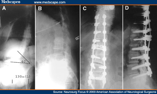 antero or retrolisthesis